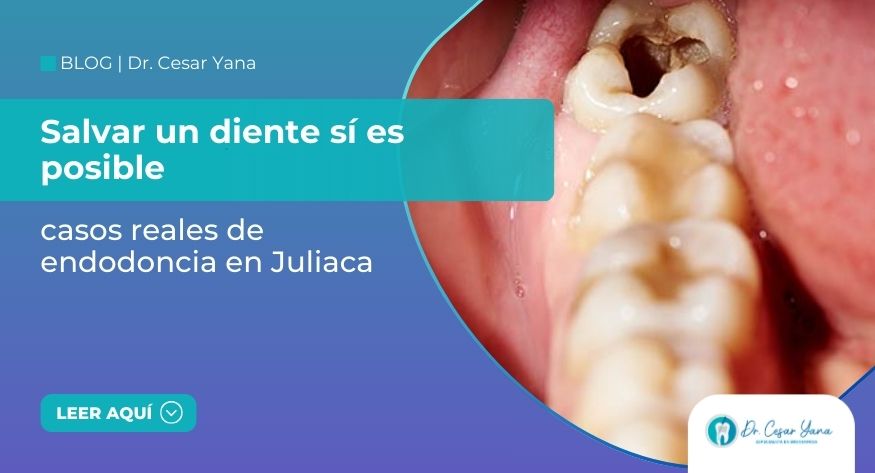 Salvar un diente sí es posible: casos reales de endodoncia en Juliaca
