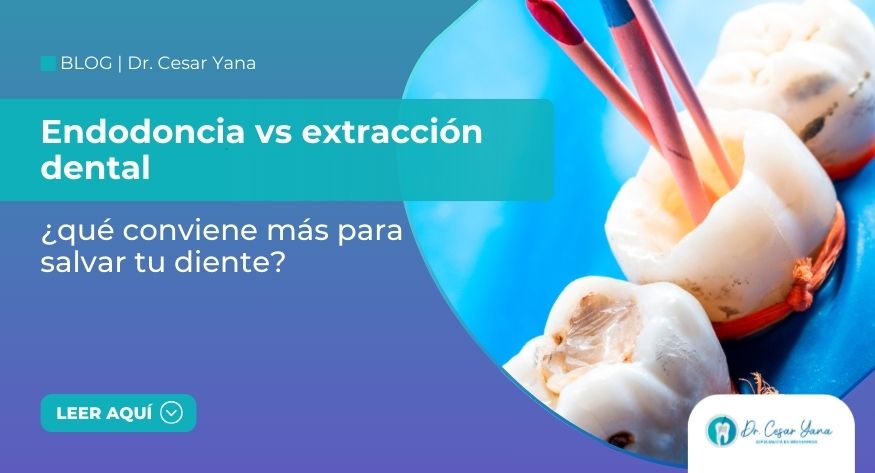 ¿qué conviene más para salvar tu diente?