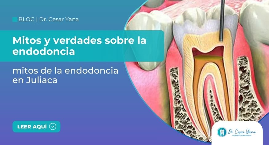 Mitos y verdades sobre la endodoncia