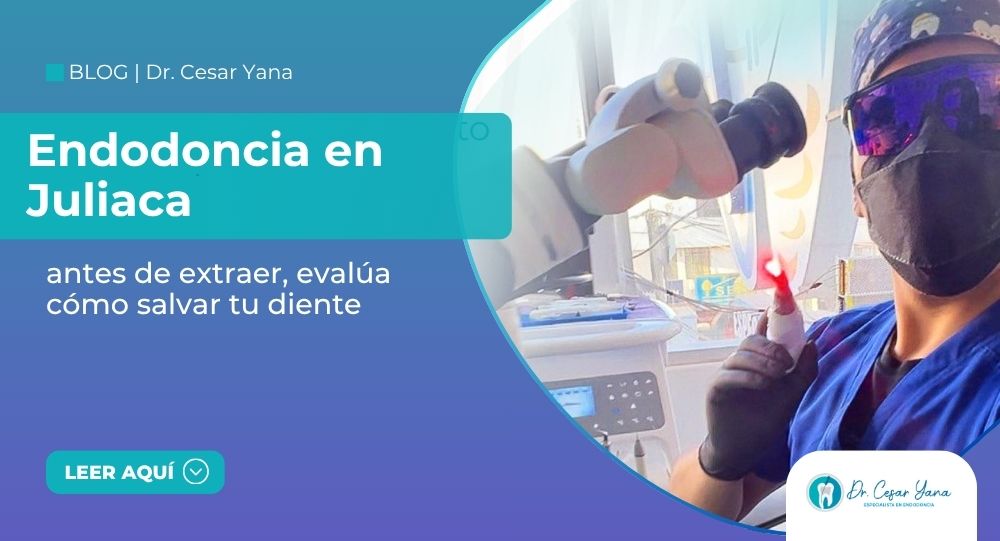 Antes de extraer, evalúa salvar tu diente con endodoncia en Juliaca. Atención especializada.